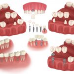 implant bridges Denver